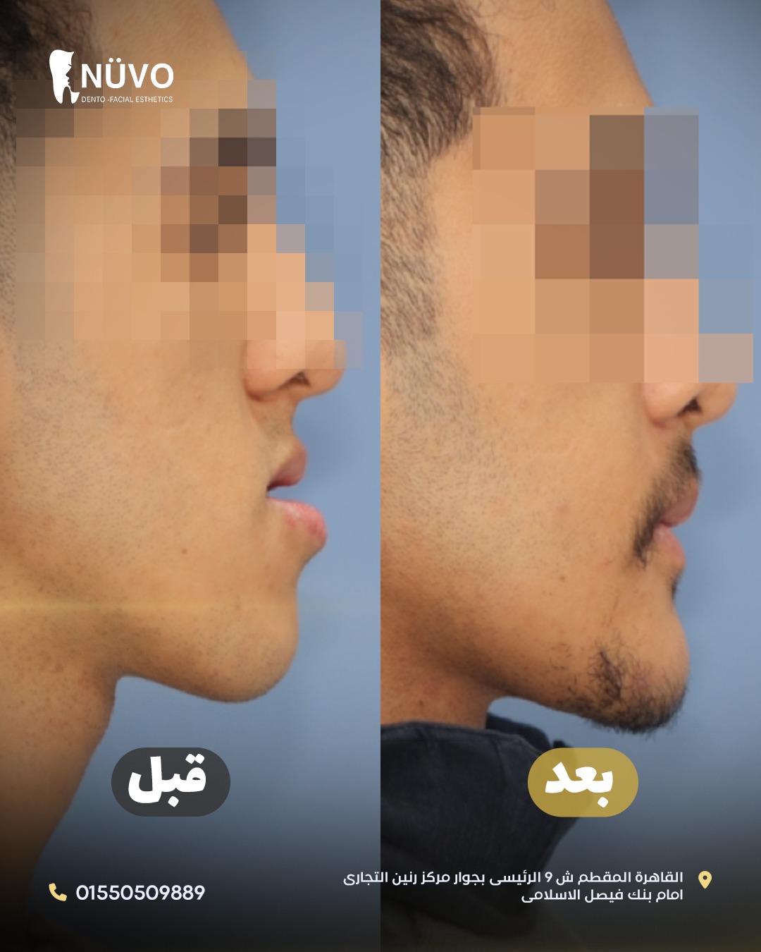 Surgical Orthodontics